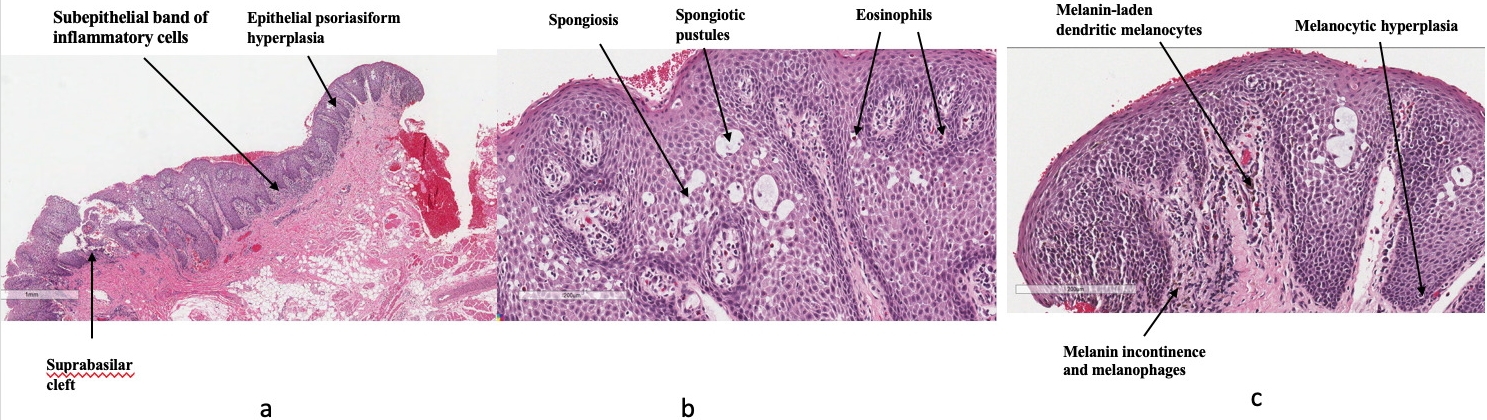 Histopathological examination. Hematoxylin and eosin-stained 
sections obtained from the left buccal mucosa through punch biopsy showing 
microabscesses. (a) Epithelium with psoriasiform hyperplasia and a suprabasilar 
cleft with a subepithelial band of inflammatory cells. (b) On high-power view, 
the epithelium demonstrates spongiosis, spongiotic pustules, and eosinophilia. 
(c) Melanocytic hyperplasia with melanin-laden dendritic melanocytes scattered 
throughout the epithelium, along with melanin incontinence and melanophages. 
Hematoxylin and eosin staining, original magnification ×40.