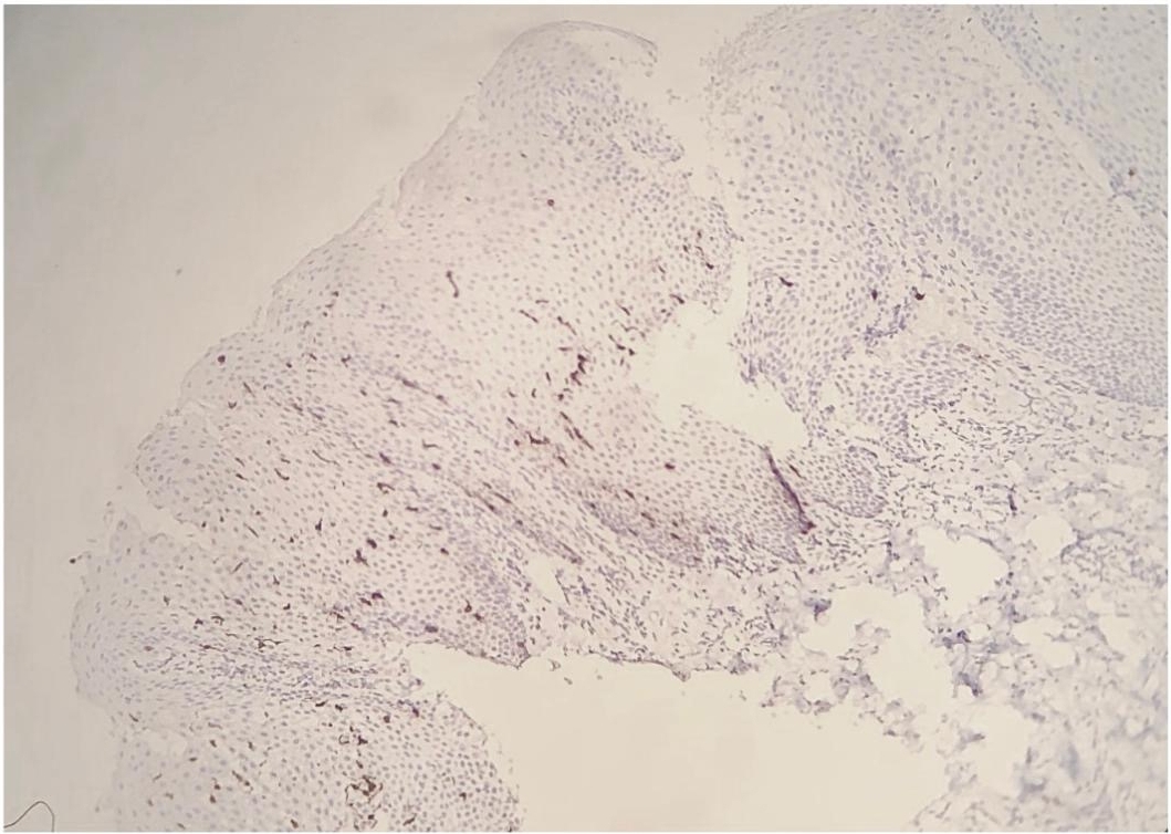 Immunohistochemical analysis. 
Specimen from the buccal mucosa showing melanin-laden dendritic melanocytes 
distributed throughout the epithelium. Melan-A, original magnification 
×40.
