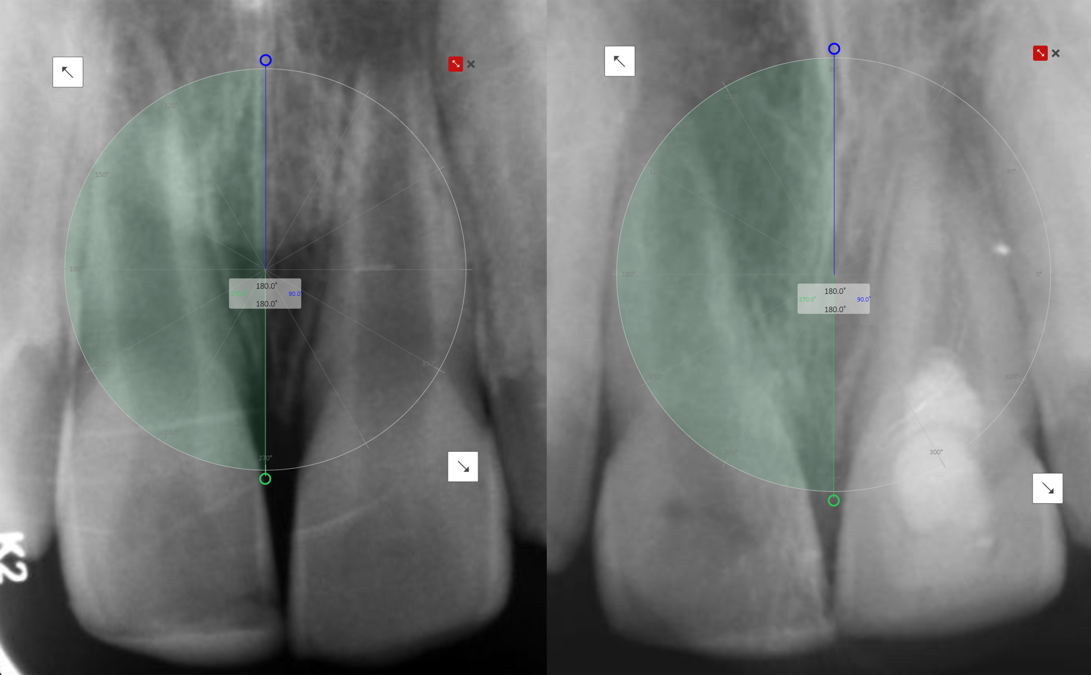 Standardization and alignment of paired periapical radiographs
(initial vs. final radiograph).