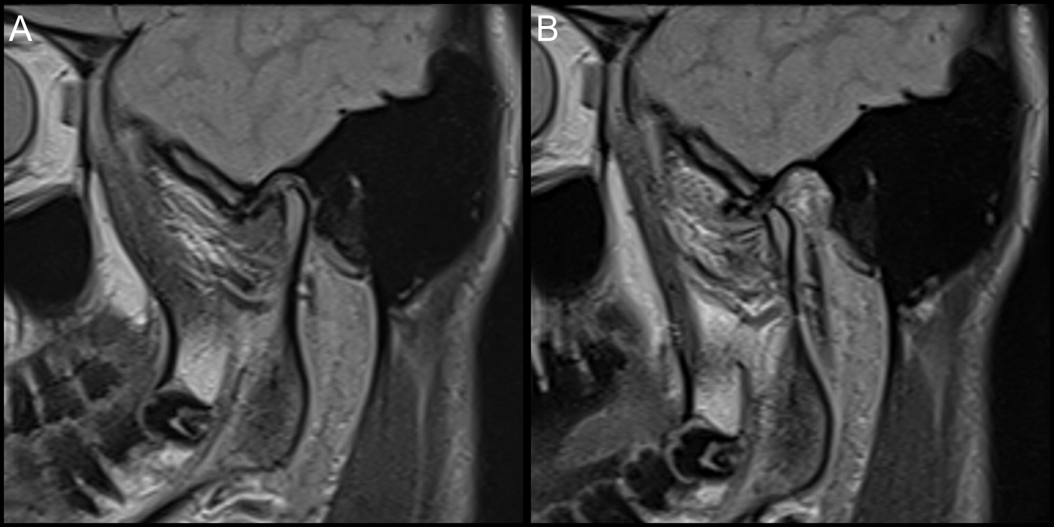 Oblique sagittal proton density-weighted magnetic resonance 
images of the temporomandibular joint. (A) Closed-mouth image showing an 
anteriorly displaced disc. (B) Open-mouth image showing a non-reduced disc 
position, consistent with anterior disc displacement without reduction.