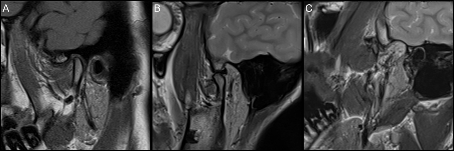 Oblique sagittal proton density-weighted magnetic resonance 
images demonstrating examples of mandibular condyle morphologies. (A) 
Closed-mouth image showing a round condyle. (B) Open-mouth image showing a flat 
condyle. (C) Open-mouth image showing a beak-shaped condyle.
