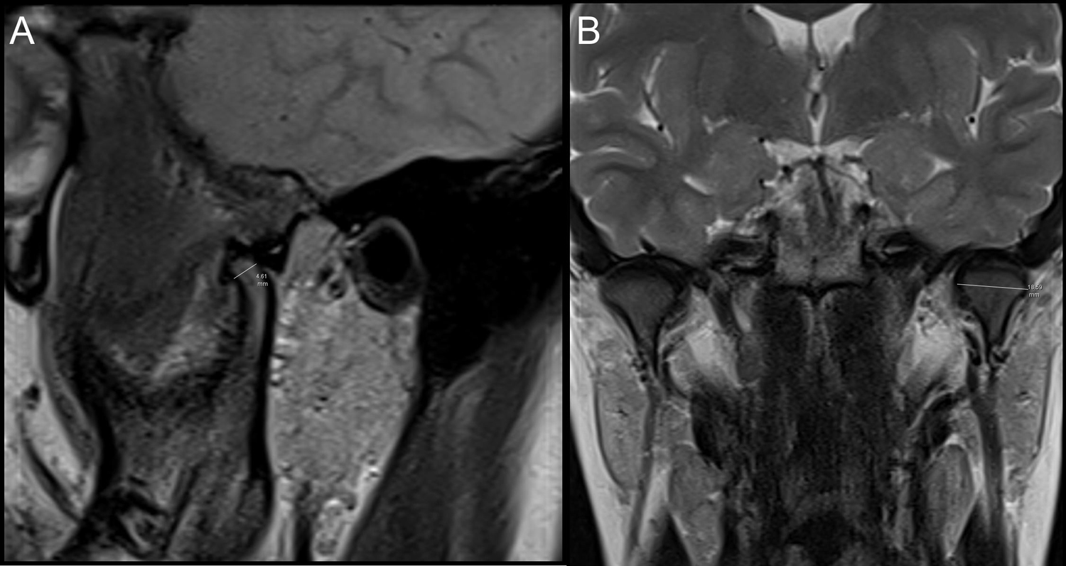 Condylar dimension measurements on magnetic resonance images. 
(A) Anteroposterior diameter measured on oblique sagittal proton 
density-weighted image. (B) Mediolateral diameter measured on coronal T2-weighted 
image.