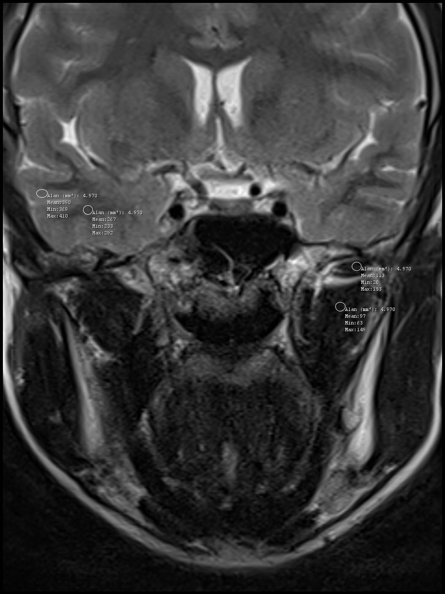 Coronal T2-weighted axial magnetic resonance image showing 
signal intensity measurements obtained using regions of interest. Measurements 
were taken from the superior and inferior heads of the lateral pterygoid muscle, 
as well as from the cerebral white and grey matter.