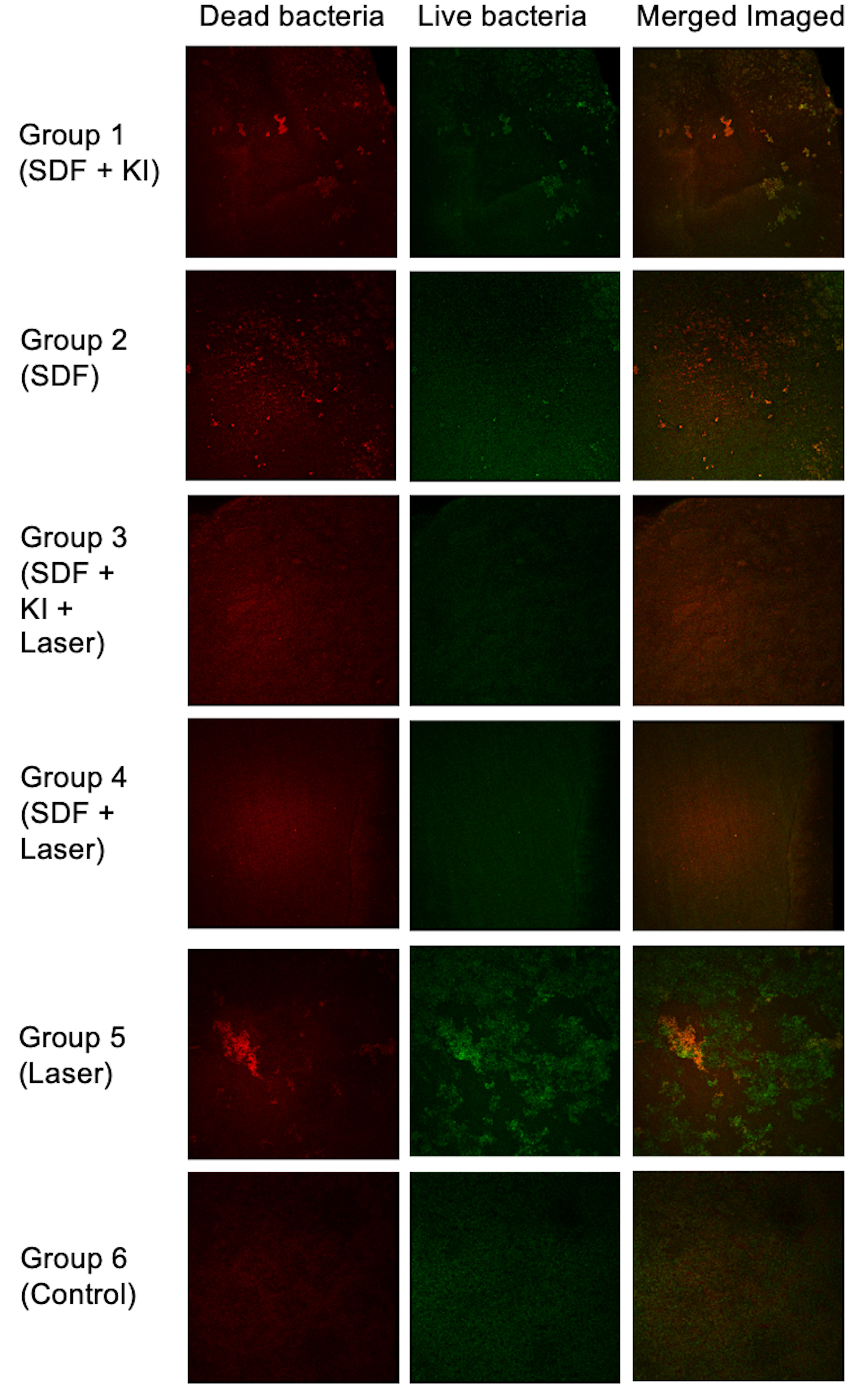 Representative confocal laser scanning microscopy (CLSM) images
of biofilms from each experimental group showing live bacteria/dead
bacteria/merged images. Within each panel, tiles represent Dead (red), Live
(green), and Merged (red + green) views
(lower-right tile left blank per export). Dead
cells = red; live
cells = green. Scale bar: 100 μm. SDF:
Silver diamine fluoride; KI: potassium iodide.