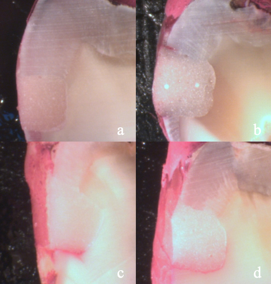 Representative images of dye penetration scores in Class V
restorations. (a) score 0: No leakage; (b) score 1: Leakage extending to half
the depth of the cavity; (c) score 2: Leakage extending beyond half the depth of
the cavity; (d) score 3: Leakage extending to the bottom of the cavity.