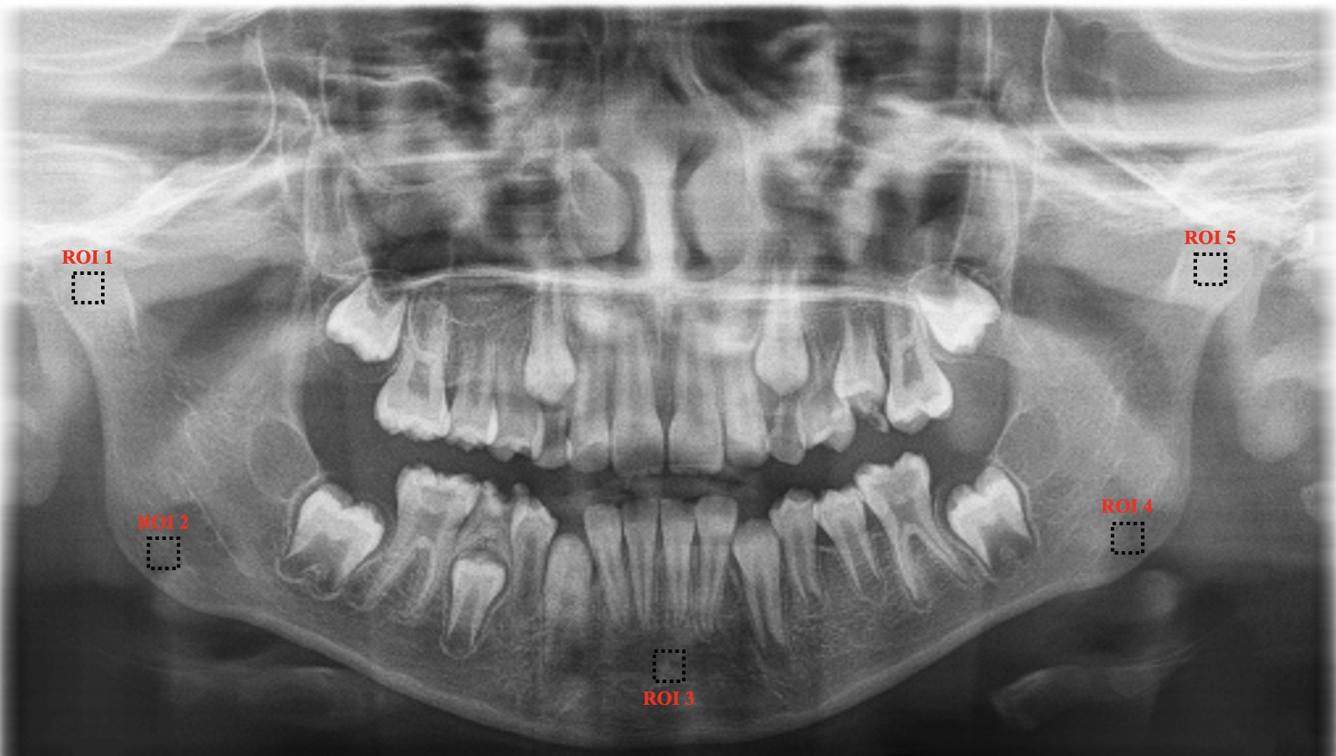 Locations of the regions of interest (ROIs) selected in
five mandibular regions.