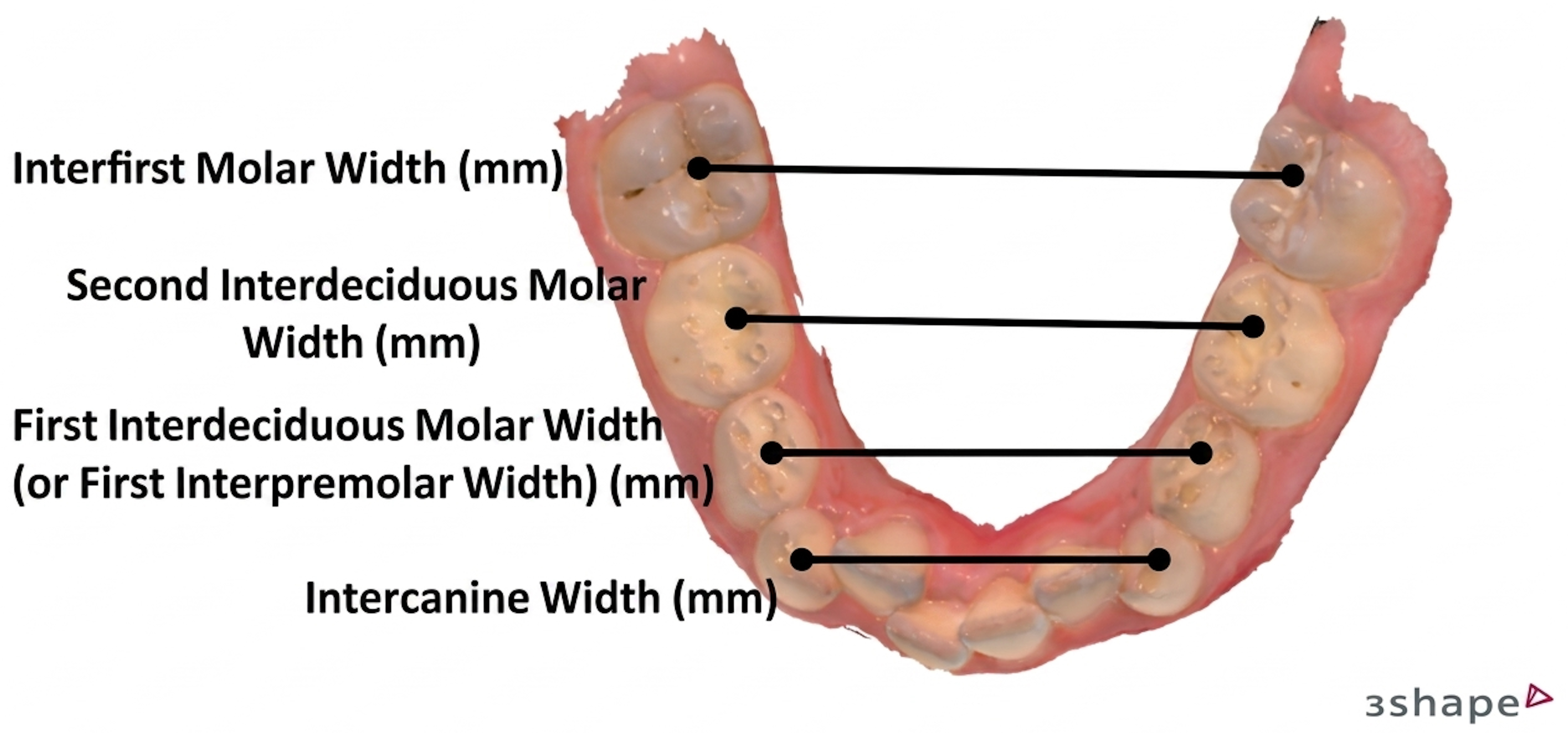 Locations of mandibular arch width measurements on the digital
model.