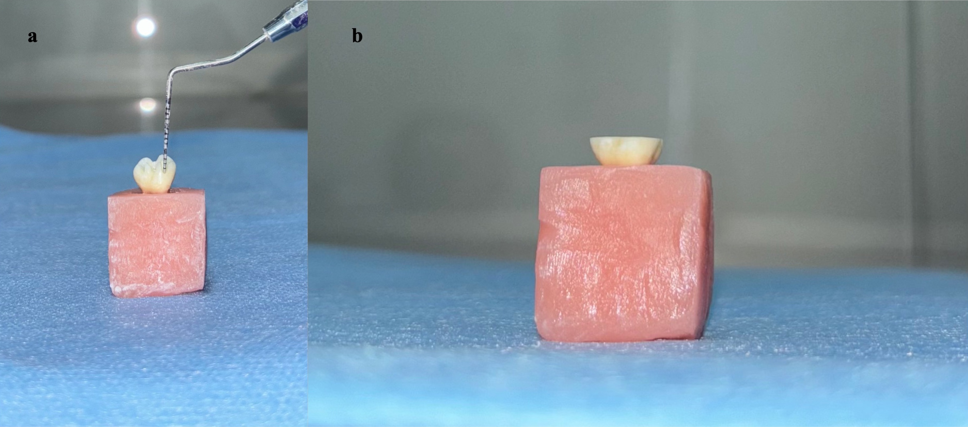 Standardized endocrown cavity preparation. (a) Preparation of 2
mm depth orientation grooves; (b) completion of occlusal reduction.