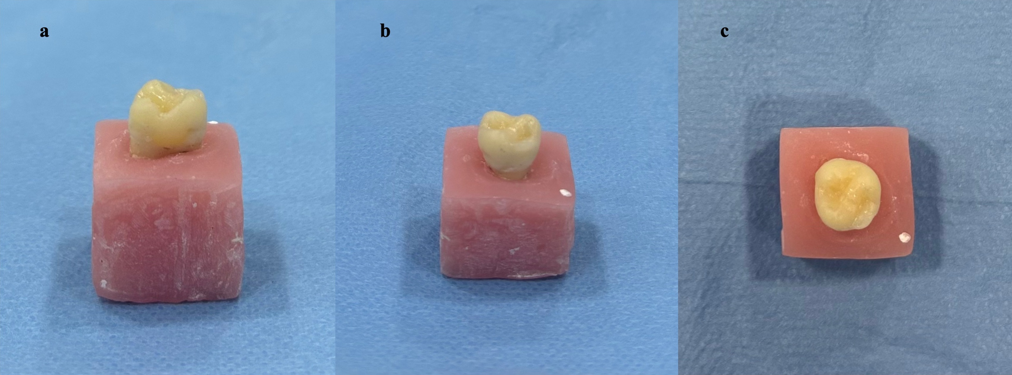Direct composite (Essentia Universal, GC Corp., Tokyo, Japan)
endocrown. (a) Mesial view of the direct composite endocrown restoration; (b)
Palatinal view of the direct composite endocrown restoration; (c) Occlusal view
of the direct composite endocrown restoration.