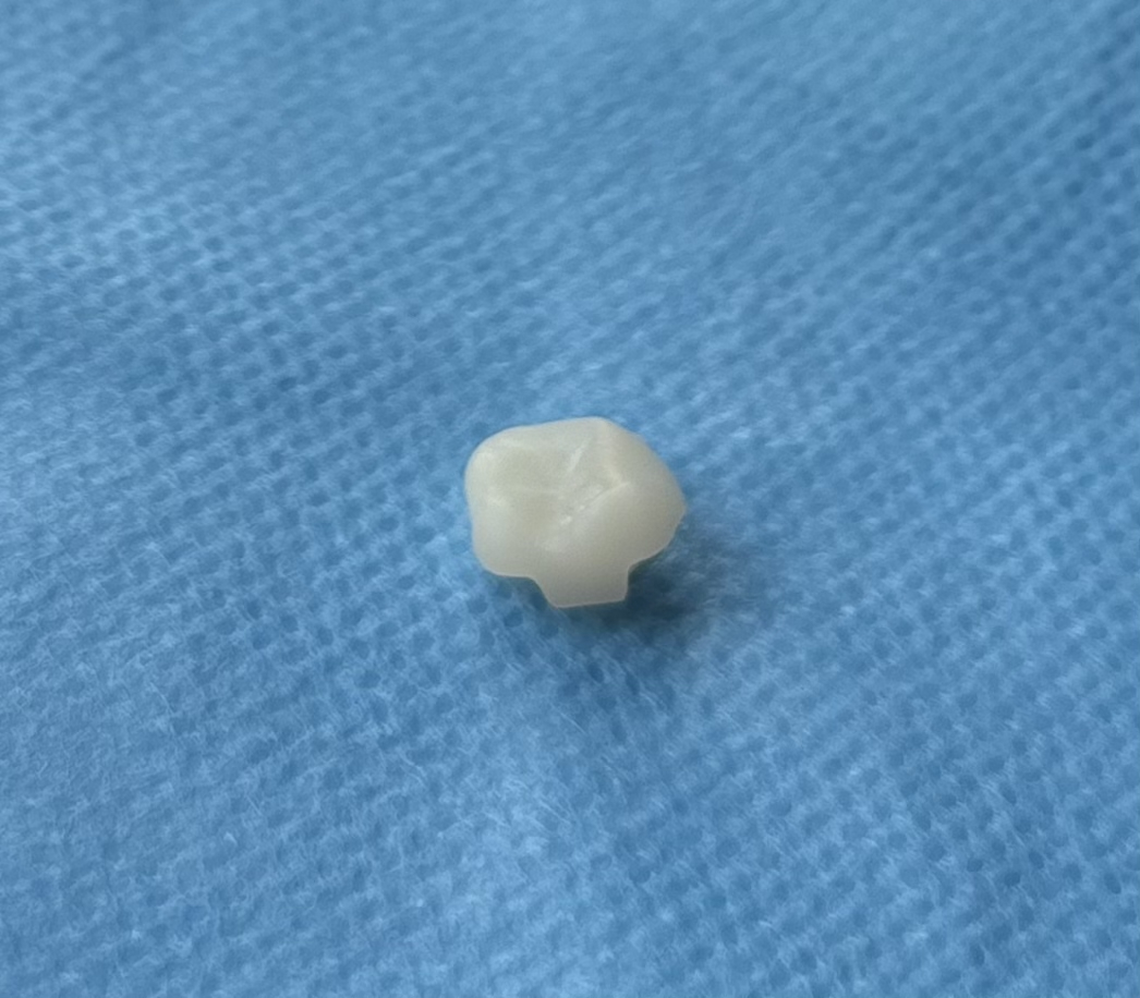 Completed CAD-CAM milled restoration.