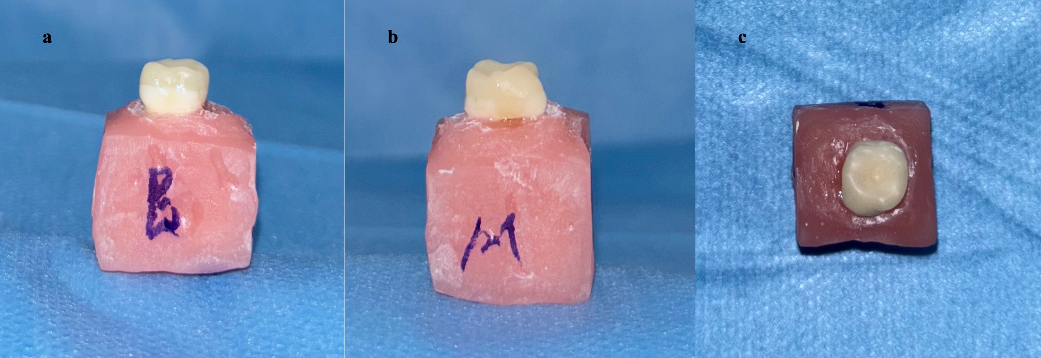Milled resin-matrix ceramic (Cerasmart 270, GC Corp., Tokyo,
Japan) endocrown restoration after adhesive cementation. (a) Buccal view of the
milled resin-matrix ceramic endocrown restoration; (b) Mesial view of the milled
resin-matrix ceramic endocrown restoration; (c) Occlusal view of the milled
resin-matrix ceramic endocrown restoration.