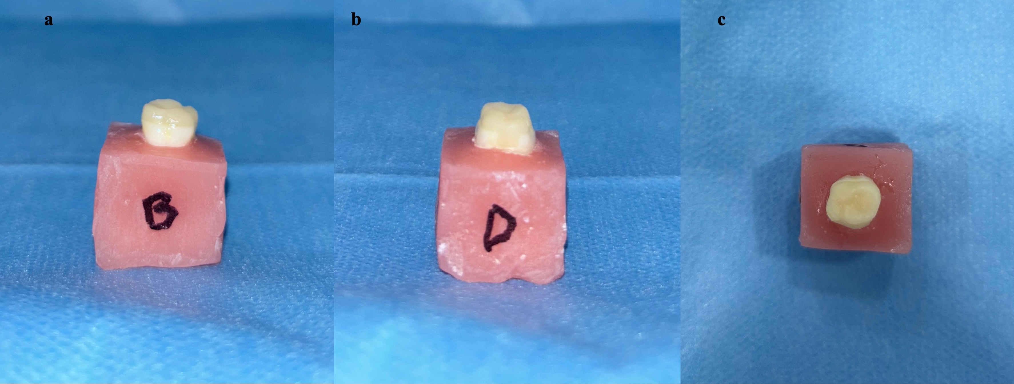 Milled composite Tetric CAD (Ivoclar Vivadent, Schaan,
Liechtenstein) endocrown restoration after adhesive cementation. (a) Buccal view
of the milled composite endocrown restoration; (b) Distal view of the milled
composite endocrown restoration; (c) Occlusal view of the milled composite
endocrown restoration.