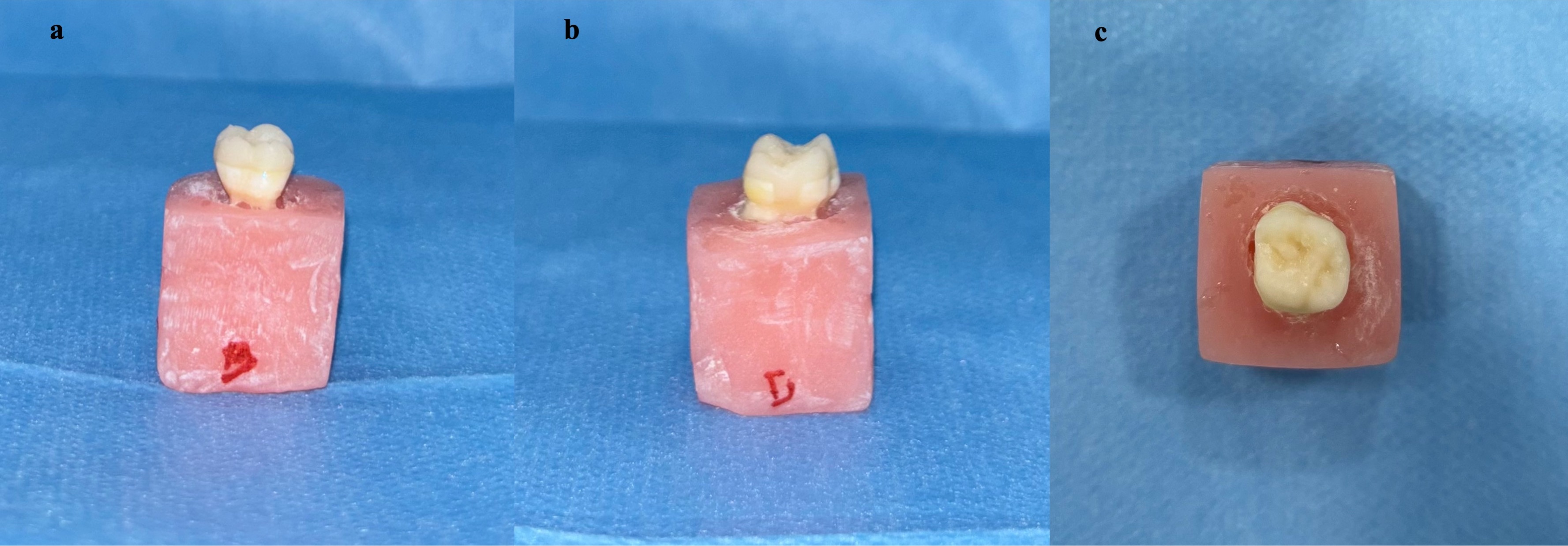 3D-printed resin (VarseoSmile Crown Plus, BEGO, Bremen, HB,
Germany) endocrown restoration after adhesive cementation. (a) Buccal view of
the 3D-printed resin endocrown restoration. (b) Distal view of the 3D-printed
resin endocrown restoration. (c) Occlusal view of the 3D-printed resin endocrown
restoration.
