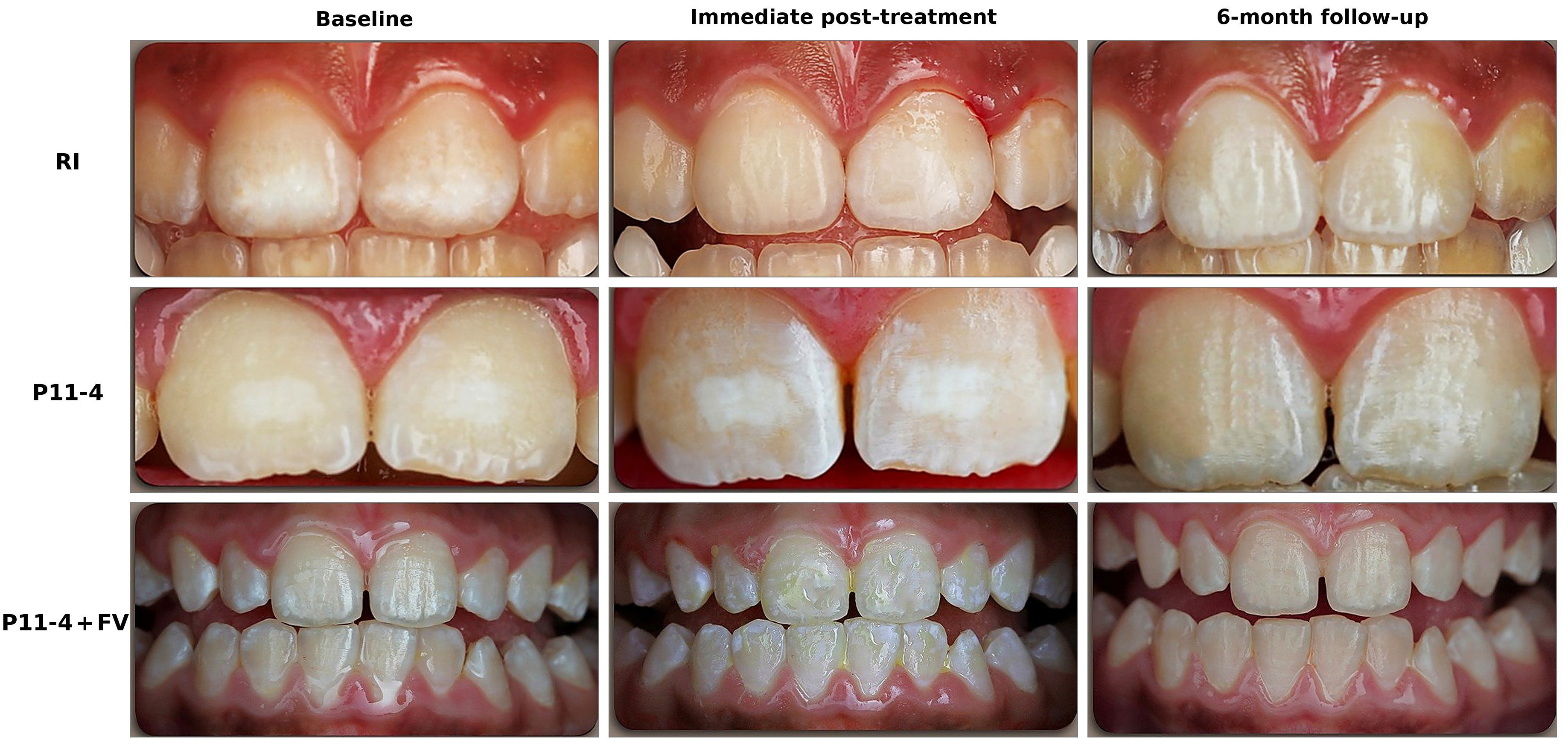Representative clinical photographs of maxillary central
incisors (FDI teeth 11 and 21) for the three treatment groups (rows) at baseline,
immediately post-treatment and 6-month follow-up (columns). Top row: resin
infiltration (RI). Middle row: self-assembling peptide P11-4. Bottom row: P11-4
with 5% sodium fluoride varnish (P11-4 + FV). Identifying facial features have
been removed. FV, fluoride varnish.