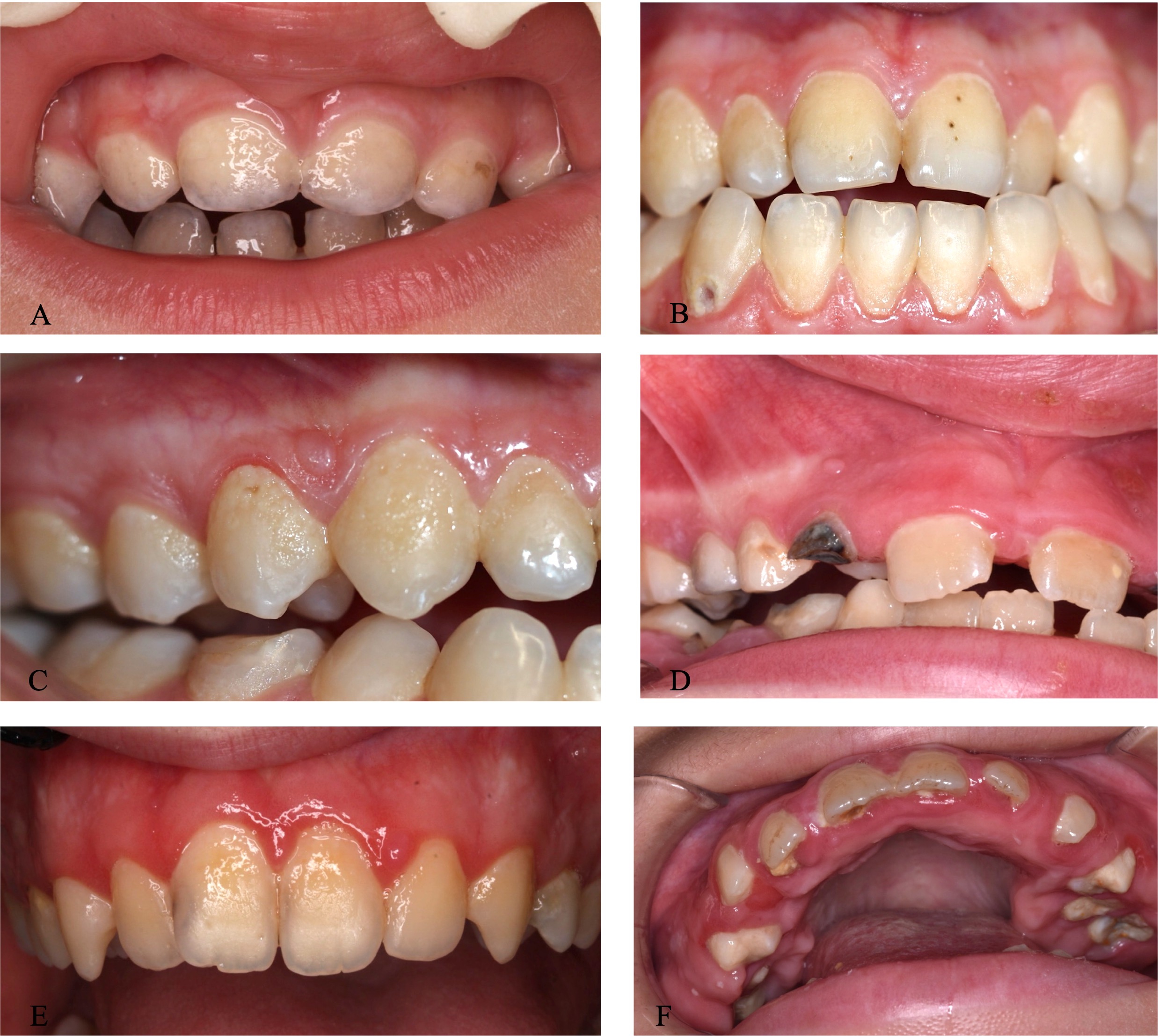 Oral lesions in children with Tuberous sclerosis complex. (A)
enamel defects on the labial surfaces of the primary maxillary incisors; (B)
discolored pits on the labial enamel surface of maxillary central incisors; (C)
fibrous proliferation in the papilla between the right maxillary canine and first
premolar; (D) fibrous proliferation in the gingiva above the right maxillary
primary lateral incisor; (E) generalized gingivitis and enamel pitting on the
labial surface of the right maxillary central incisor; (F) severe generalized
gingival hyperplasia.