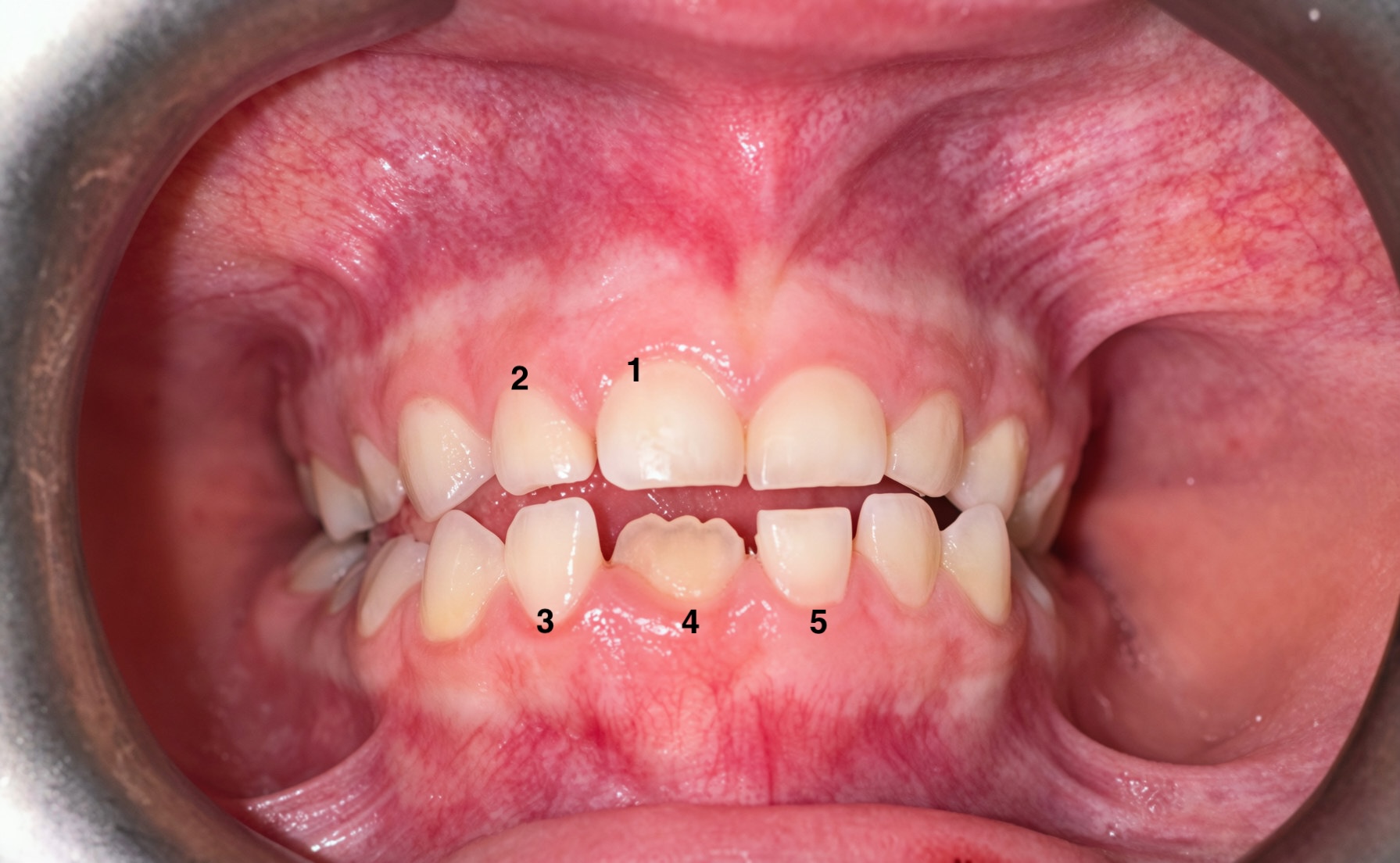 Parental knowledge, awareness and competence about first permanent molars: their associations with clinical outcomes and oral health literacy figure 2