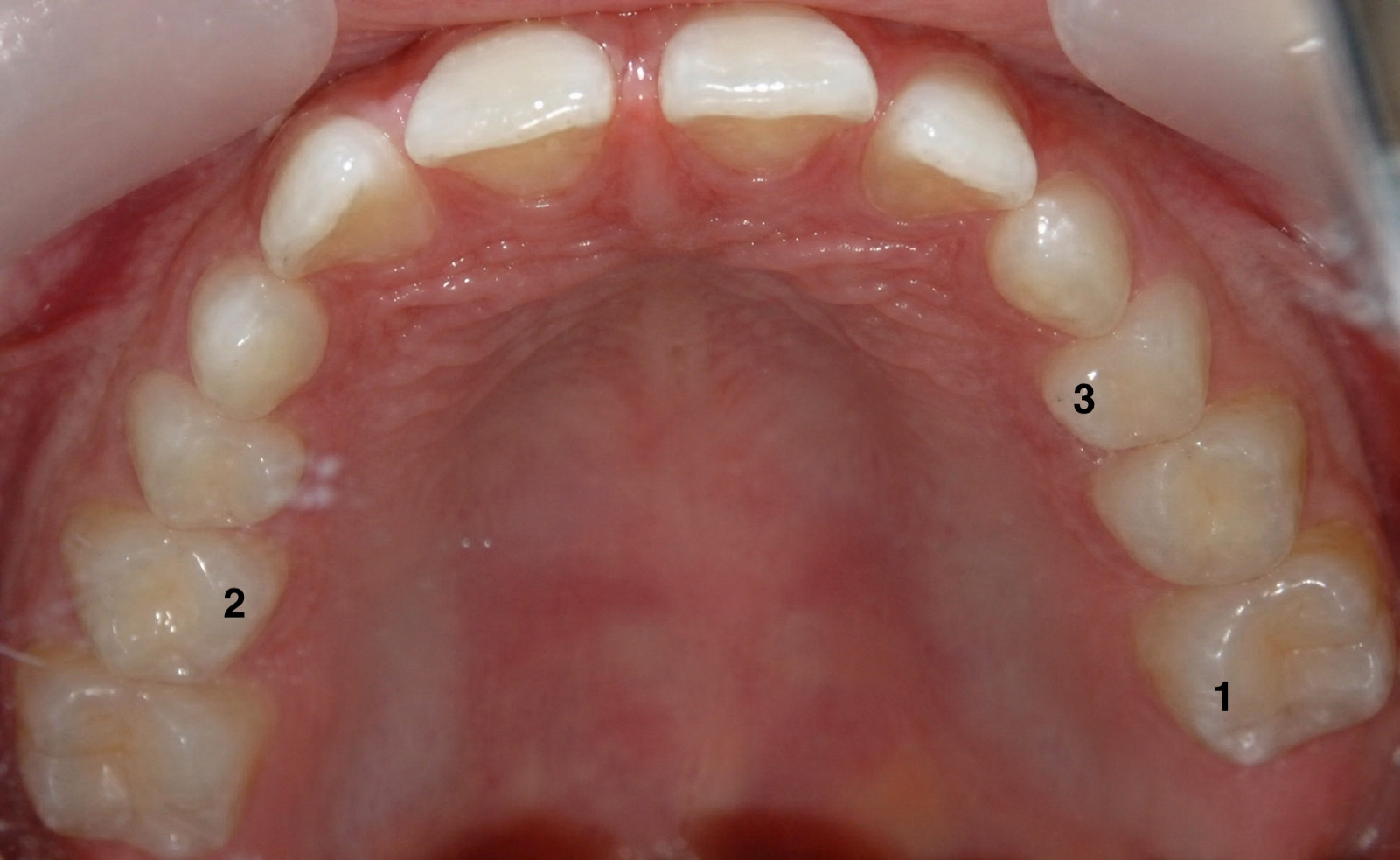 Parental knowledge, awareness and competence about first permanent molars: their associations with clinical outcomes and oral health literacy figure 3