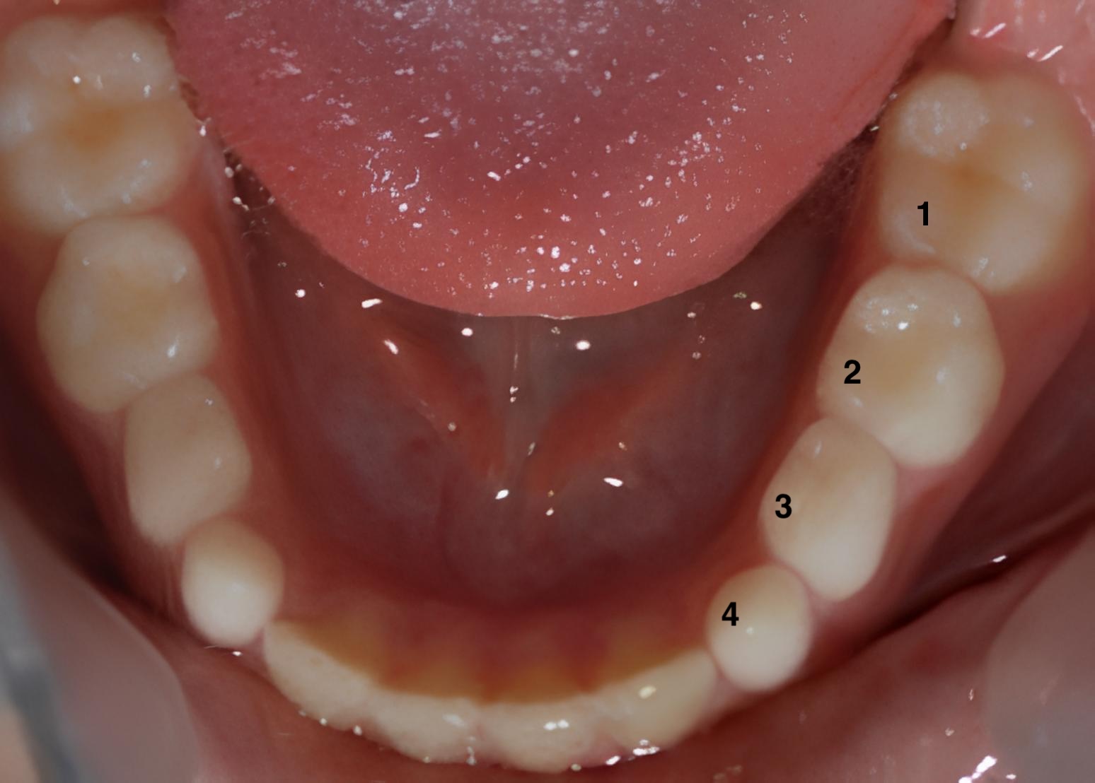 Parental knowledge, awareness and competence about first permanent molars: their associations with clinical outcomes and oral health literacy figure 4