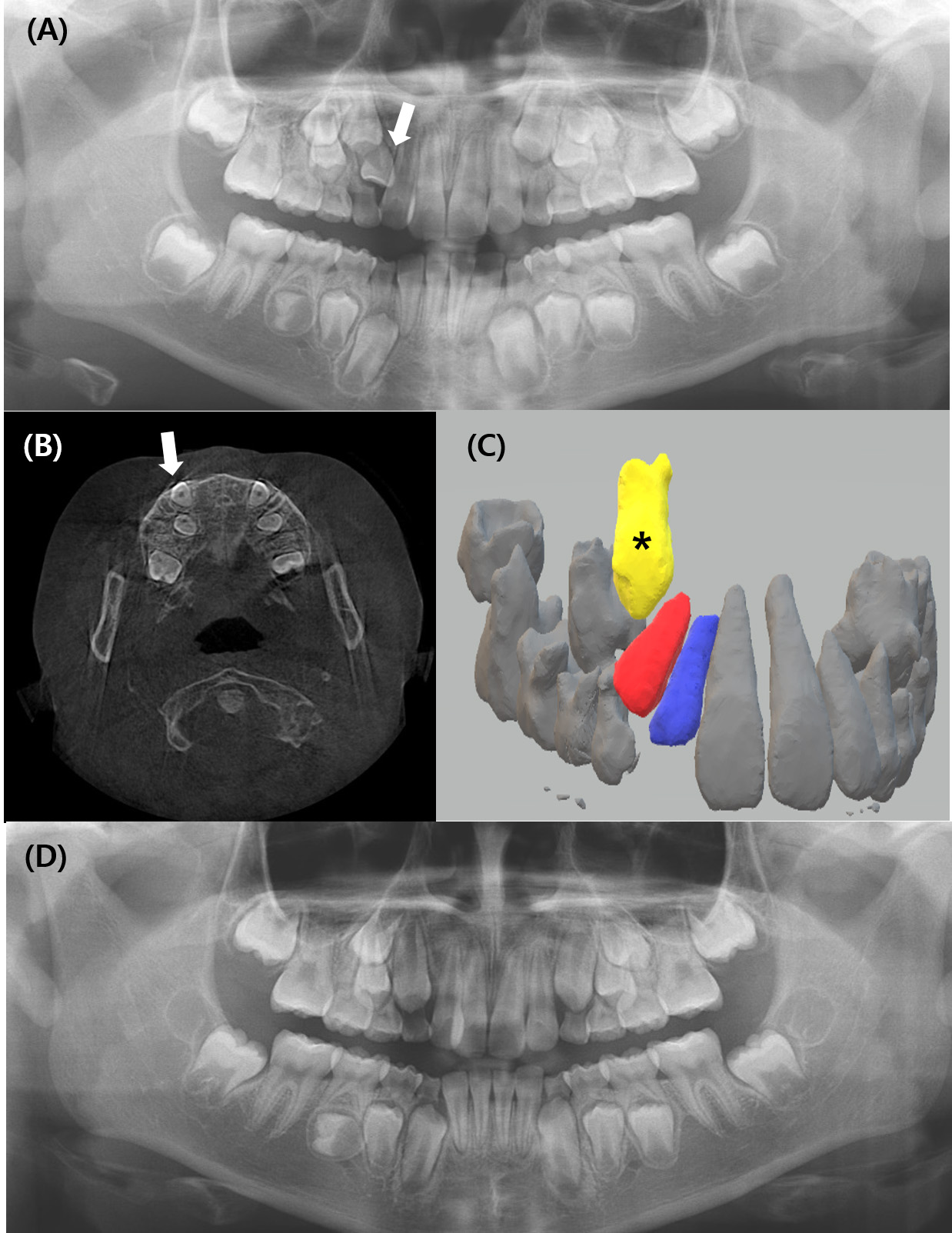 Radiographic findings of Case 1. (A) Preoperative panoramic
radiograph showing the impacted supplemental maxillary lateral incisor (arrow).
(B) Preoperative axial CBCT image depicting the buccal position of the maxillary
canine (arrow). (C) Preoperative 3D reconstruction illustrating the spatial
relationship among the maxillary canine (yellow, asterisk), the supplemental
lateral incisor planned for extraction (red), and the retained lateral incisor
(blue). (D) Postoperative panoramic radiograph showing the canine progressing
along a favorable eruption path.