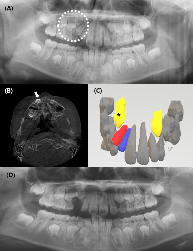 Radiographic findings of Case 2. (A) Preoperative panoramic
radiograph showing a peg-shaped supplemental maxillary lateral incisor (circle).
(B) Preoperative axial CBCT image illustrating the buccal position of the
maxillary canine (arrow). (C) Preoperative 3D reconstruction showing the spatial
relationship among the maxillary canine (yellow, asterisk), the supplemental
lateral incisor planned for extraction (red), and the retained lateral incisor
(blue). (D) Postoperative panoramic radiograph demonstrating eruption of the
lateral incisor and the canine progressing along a favorable eruption path.