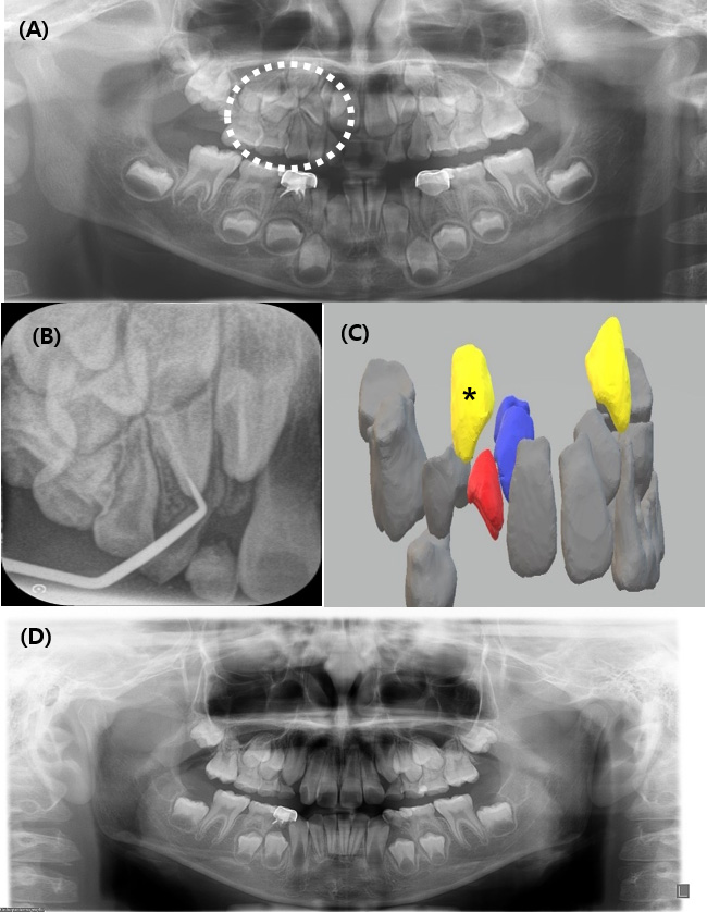 Radiographic findings of Case 3. (A) Initial panoramic
radiograph showing duplication of the primary and permanent maxillary lateral
incisors (circle). (B) Preoperative periapical radiograph demonstrating the right
permanent supplemental lateral incisor. (C) Preoperative 3D reconstruction
illustrating the spatial relationship among the maxillary canine (yellow,
asterisk), the supplemental lateral incisor planned for extraction (red), and the
retained lateral incisor (blue). (D) Postoperative panoramic radiograph showing
the canine progressing along a favorable eruption path.
