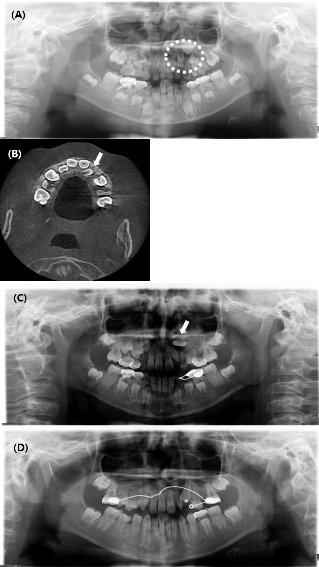 Radiographic findings of Case 4. (A) Initial panoramic
radiograph showing a left maxillary supplemental lateral incisor (circle),
multiple carious lesions in primary molars, and congenital absence of the left
maxillary second premolar. (B) Preoperative axial CBCT image illustrating palatal
displacement of the left maxillary canine (arrow). (C) Postoperative panoramic
radiograph obtained 18 months after extraction, showing ectopic displacement of
the left maxillary canine (arrow). (D) Postoperative panoramic radiograph
obtained 51 months after extraction, showing orthodontic traction of the left
maxillary canine.