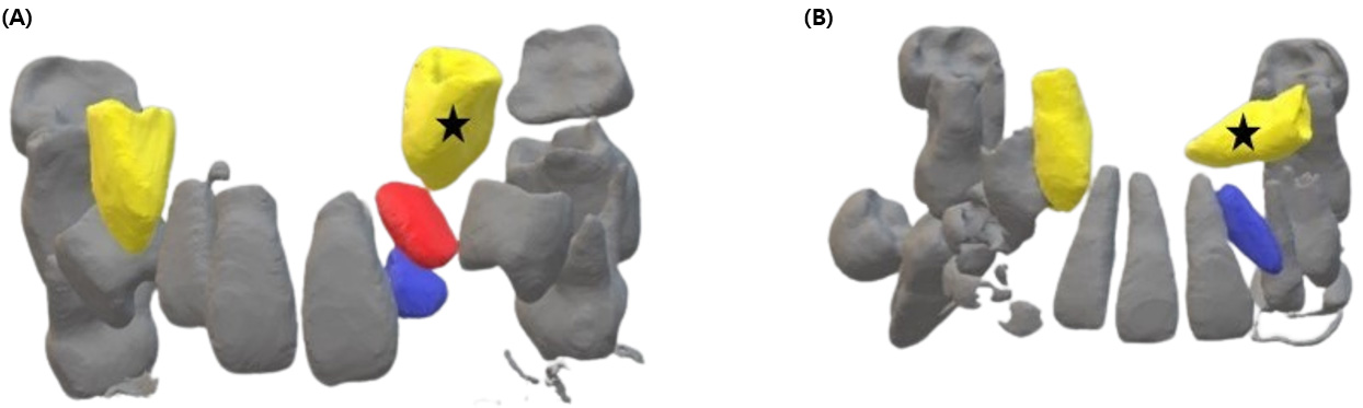 3D reconstruction of Case 4. (A) Preoperative 3D reconstruction
showing the position of the left maxillary canine (yellow, asterisk) relative to
the supplemental lateral incisor to be extracted (red) and the retained lateral
incisor (blue). (B) Postoperative 3D reconstruction illustrating ectopic
displacement of the left maxillary canine (yellow, asterisk) and clinical
eruption of the retained lateral incisor (blue).