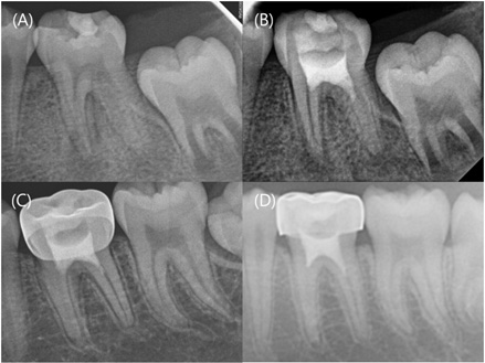Serial periapical radiographs of Case 1. (A) Pre-treatment 
periapical radiograph of the left mandibular first molar. (B–D) Radiograph at 
the 2-month, 4-year 4-month, 6-year follow-ups, demonstrating continued root 
development and progressive canal narrowing.