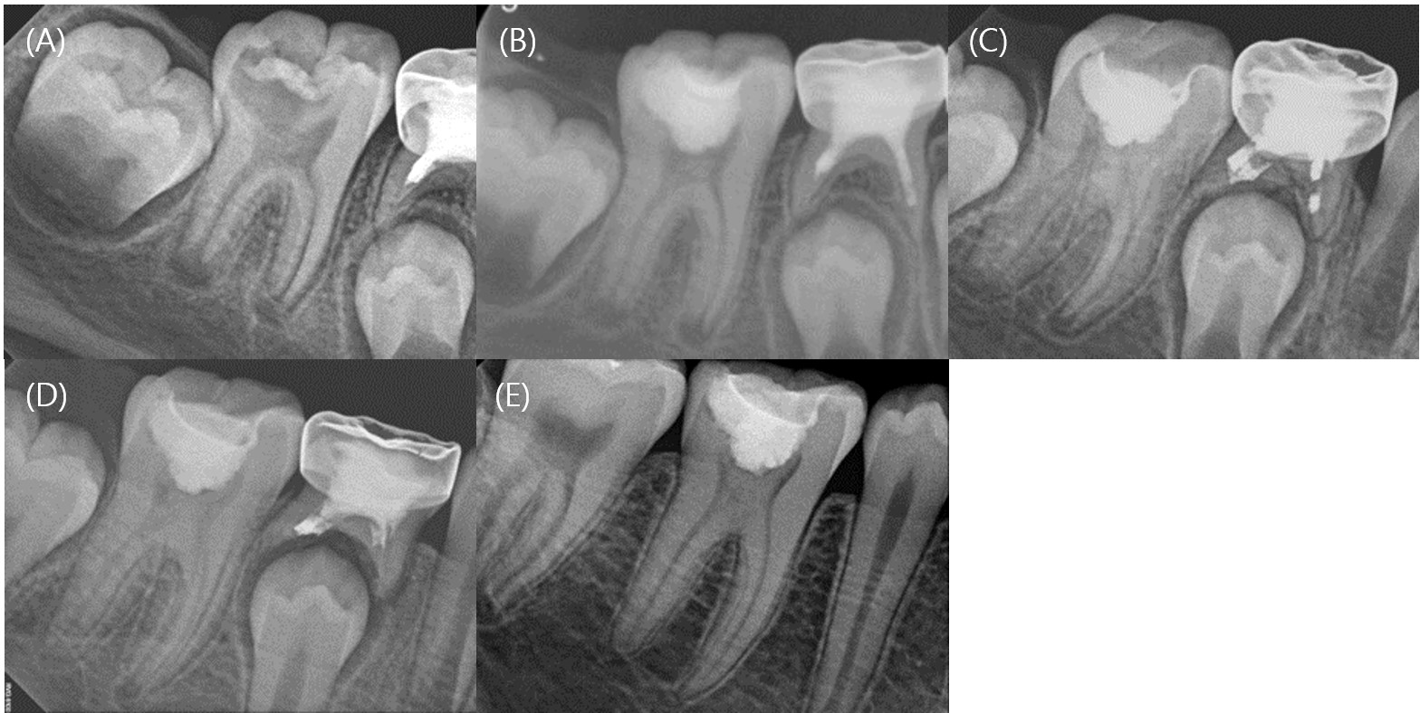 Serial periapical radiographs of Case 2. (A) Pretreatment 
periapical radiograph of the mandibular right first molar. (B–E) Radiographs at 
the 3-month, 15-month, 2-year, 5-year follow-ups demonstrating continued root 
development, apical closure, and progressive canal narrowing.