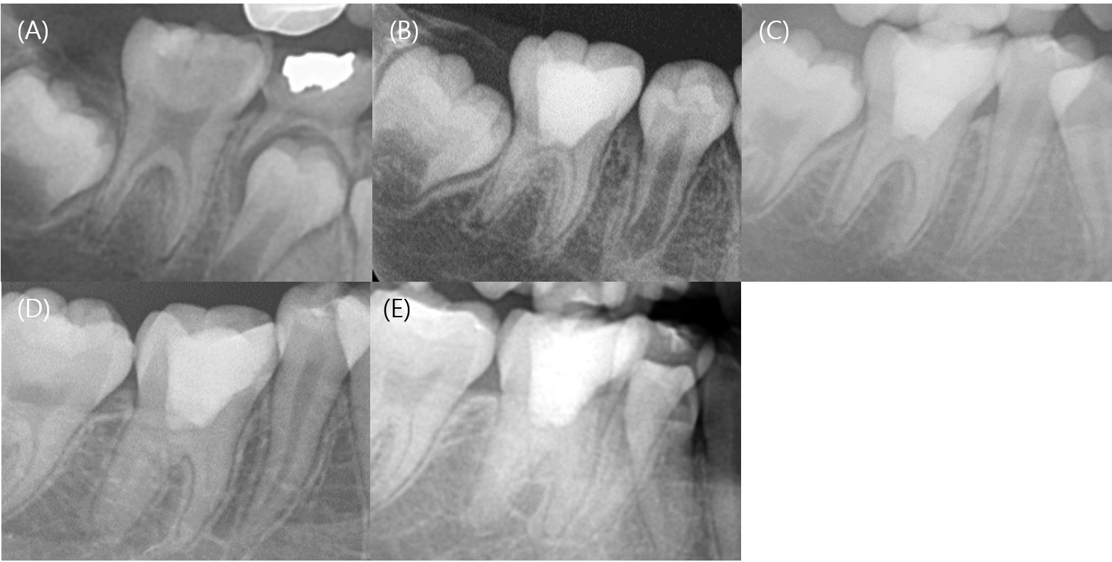Serial periapical radiographs of Case 3. (A) Pretreatment 
periapical radiograph of the mandibular right first molar. (B–E) Radiographs at 
the 14-month, 3-year, 5-year, and 10-year follow-ups demonstrating continued root 
development, apical closure, and stable radiographic findings with progressive 
canal narrowing.